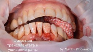 Закрытие рецессии десны. 1 Этап. перевод 2 класса в первый.