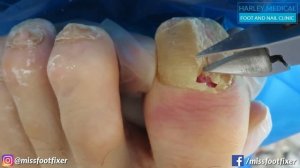 How to Treat Paronychia by Miss Foot Fixer Marion Yau