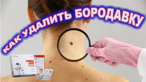 Как удалить бородавку. Хемохим отзыв