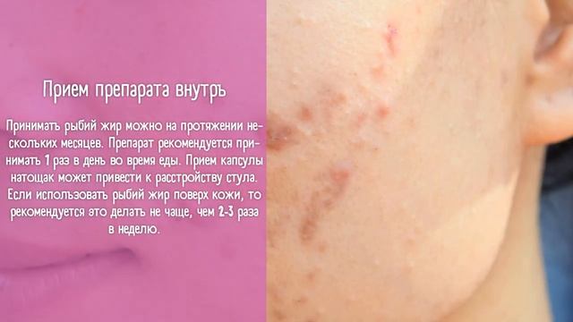 Этого Прыщи Боятся? Делаем Маски от Прыщей