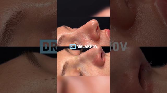 Первичная риносептопластика 🔥