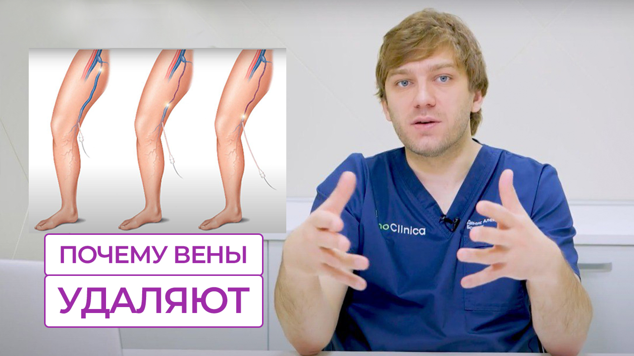 Почему при варикозе удаляют расширенные вены