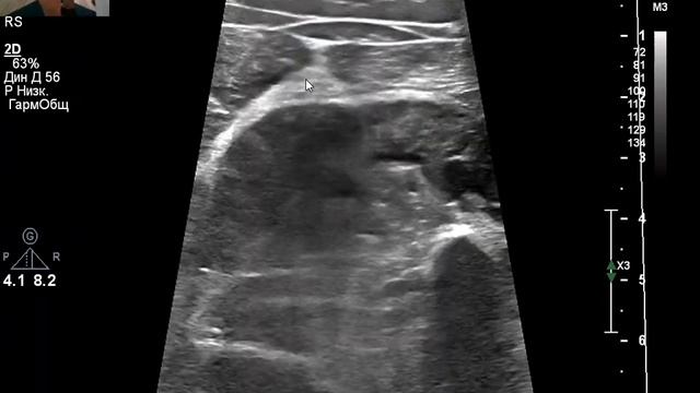УЗИ вен. Суральный тромбоз. Женщина. смотреть онлайн