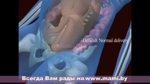 Тазовое предлежание плода