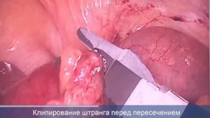Лапароскопия кишечника. Странгуляционная кишечная непроходимость