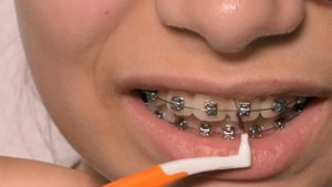 Уход за брекетами. Как чистить брекеты?