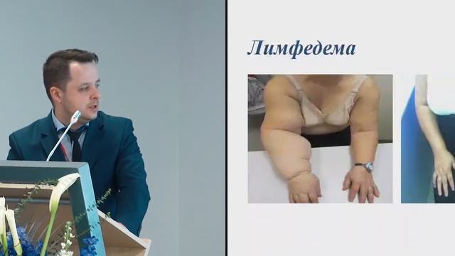 Факторы развития лимфедемы у больных с диагнозом РМЖ после хирургического лечения. Ткачев М.В. смотреть онлайн