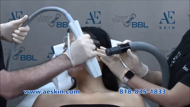 Forever Young BBL IPL Photofacial Demo 51 Jackie Fernandez - A E Skin - Encino, CA - 818-835-1833 смотреть онлайн