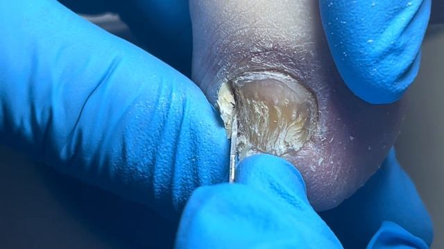 The little fingernail is infected with bacteria and the whole thing is brokenPedicureMaster LinJun