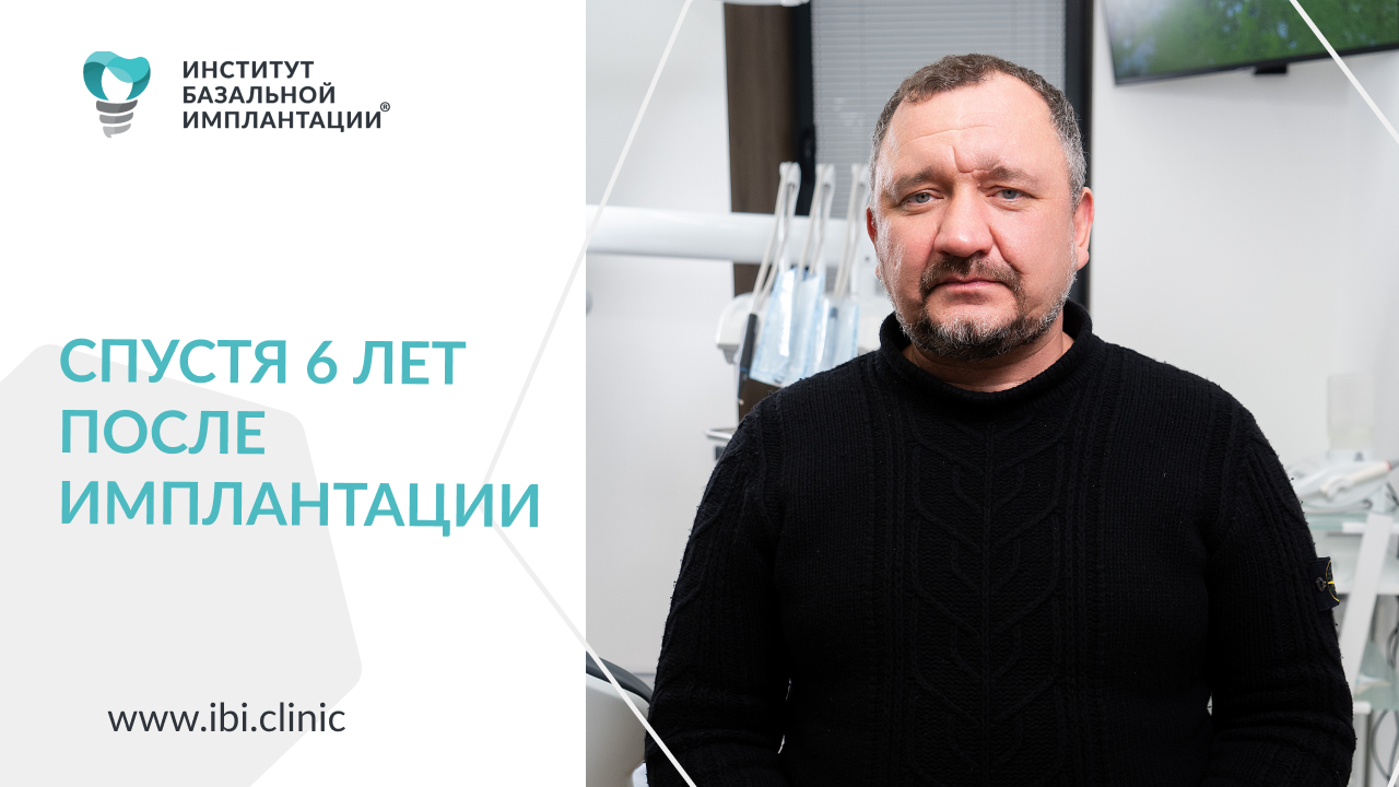 6 лет после имплантации зубов в ИБИ/Замена сегментов