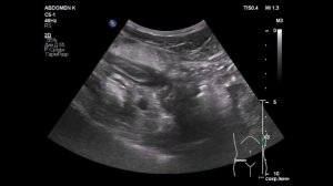Отрый аппендицит, периаппендикулярный инфильтрат с абсцедированием у верхушки чер-го отростка