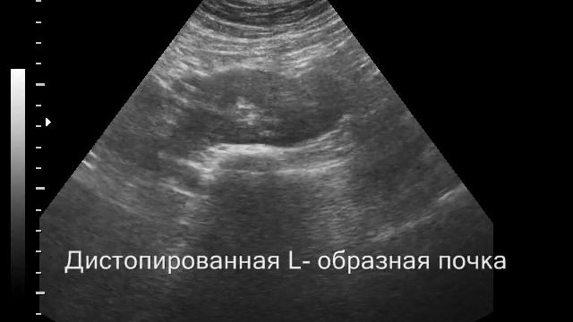 Подвздошная дистопия L  образной почки