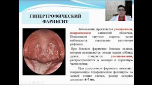 Острые и хронические фарингиты