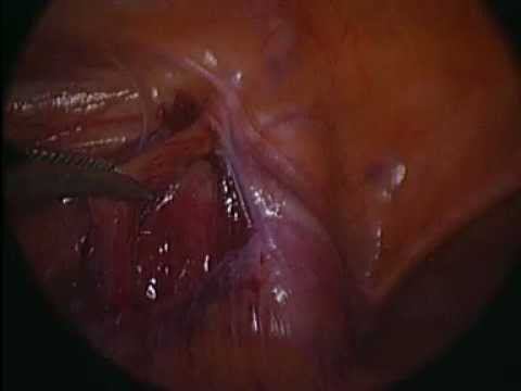 Варикоцеле немонтированное видео Аболмасов А.В..wmv смотреть онлайн