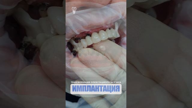 Трансформация зубов пациента за 2 часа. Transformation of the patient's teeth in 2 hours.