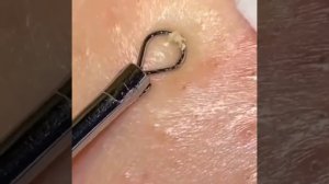 acne,cleaners,pimple popping,blackhead removal,pimple popper Музыка:See YouМузыкант: @iksonmusic