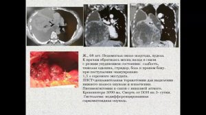 Туберкулез средостения. Хирургическое лечение массивных опухолей грудной полости