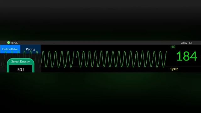 желудочковая тахикардия + кардиоверсия. смотреть онлайн