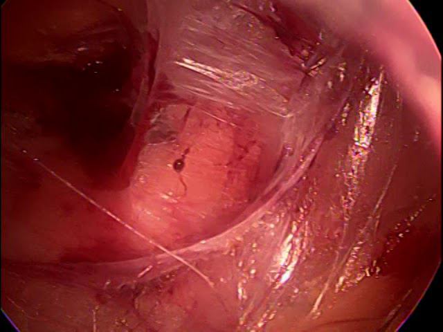 laparoscopic eTEP retorectus diastasis repair non edited video смотреть онлайн