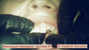 Фиксация иммедиат протеза 12- 21.  Кейс #1.