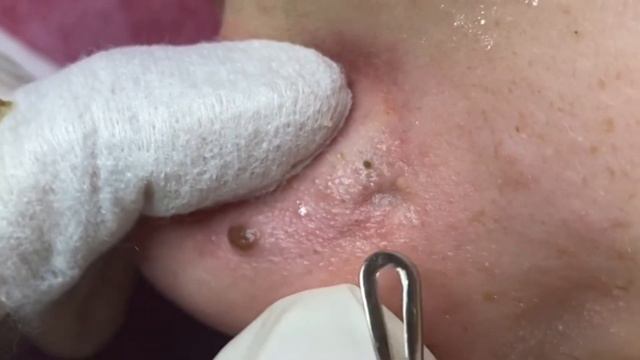 粉刺 粟粒腫 Самое залипательное видео давить прыщи Черные точки Dermatologist video to press pimples смотреть онлайн