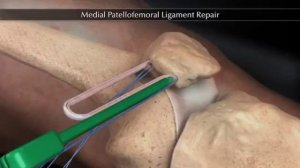 Пластика пателло-феморальной связки (Medial Patellofemoral Ligament Repair)