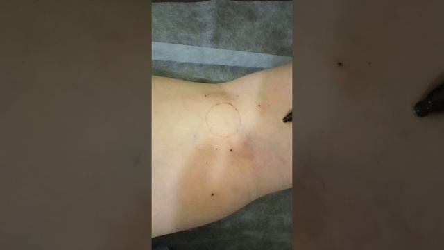 киста Беккера, после первой приставки уменьшилась в два раза. Поставим второй раз, после варикоза.. смотреть онлайн