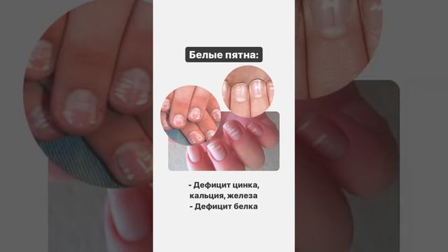 Как заболевания отражаются на ногтях? Изменения ногтей