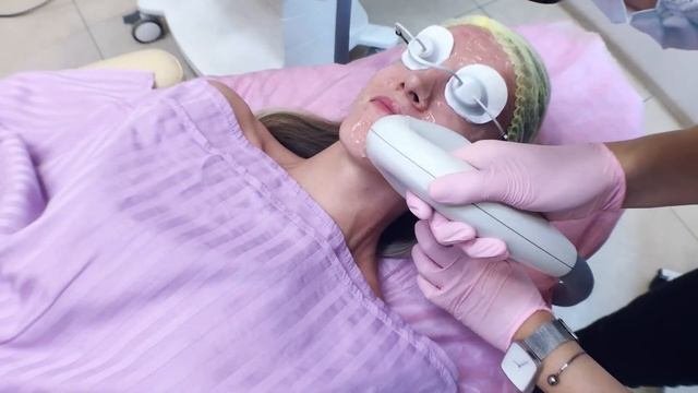 Лечение акне и постакне - IPL фотоомоложение M22