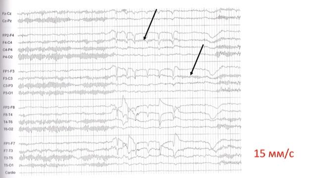 Каппа ритм на ЭЭГ. Аркообразный ритм на ЭЭГ.