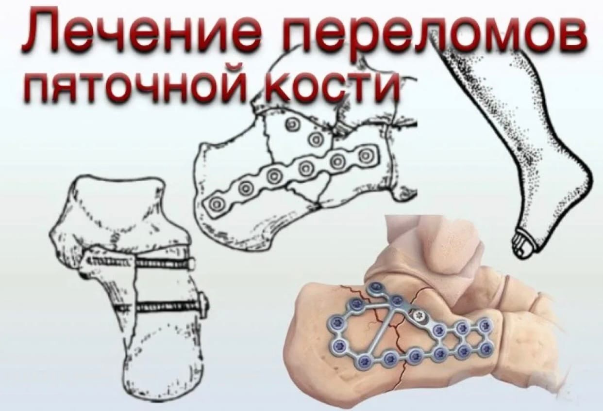 Как лечить трещину кости. Перелом пяточной кости аппарат Илизарова. Механизм перелома пяточной кости. Многооскольчатый перелом пяточной кости.