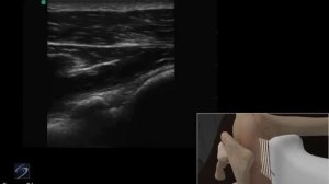 3D-пособие: инъекция в плечевой сустав при медиальном доступе под ультразвуковым контролем