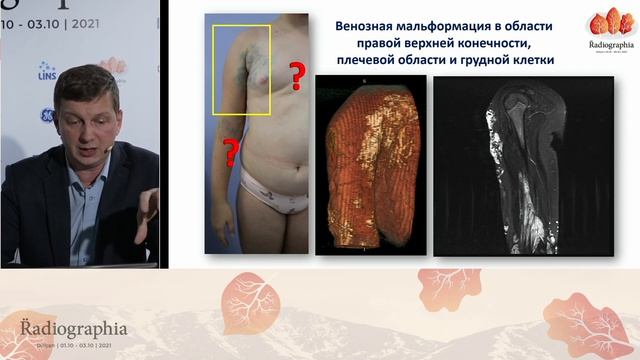 Дмитрий Романов. Москва. Сосудистые мальформации у детей - визуализация и тактика. смотреть онлайн