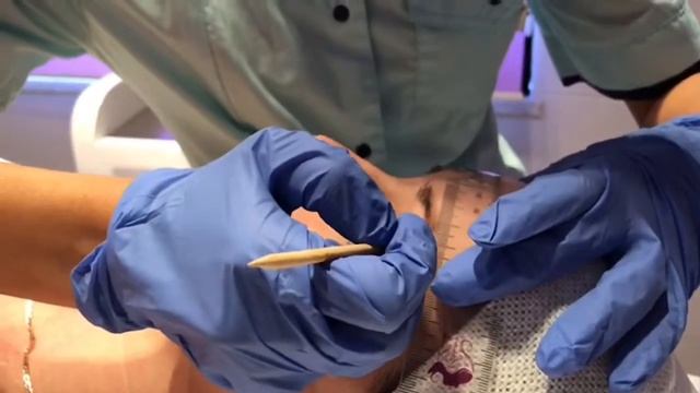 Лазерное удаление татуажа бровей. смотреть онлайн