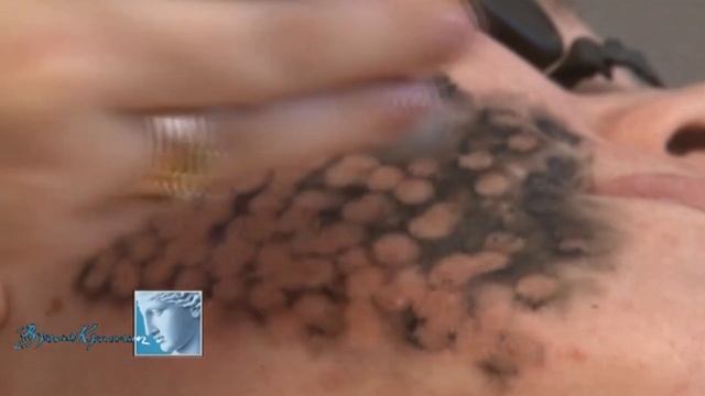 Лазеpный комплекс Мультилайн смотреть онлайн