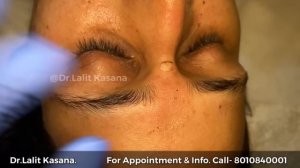 Mole Removal in 2 Minutes by Dr.Lalit Kasana (+91-8010840001)