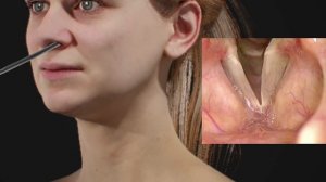 3 Different Methods of Vocal Cord Paralysis Treatment via Needle Injection