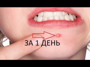 7 ПРОСТЫХ СПОСОБОВ избавится от ПРЫЩЕЙ за 1 ДЕНЬ