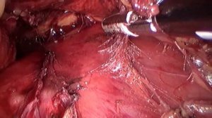 Laparoscopic Huge nephradrenalectomy aortocaval LND LIVE _ Нефрадреналэктомия ли.mp4