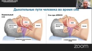 Как избавиться от АПНОЭ Причины остановки дыхания во время сна. Руденко В.В. Академия Целителей.mp4