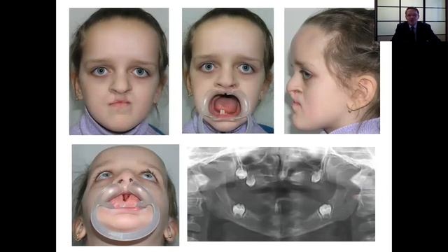 Челюстно-лицевое протезирование детей и взрослых (опыт 20-летней практической деятельности). смотреть онлайн