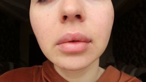 НЕ ПРИНИМАЙ РОАККУТАН, НЕ ПОСМОТРЕВ ЭТО ВИДЕО / ЛЕЧЕНИЕ АКНЕ / Ayka Emilly