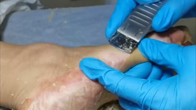 Podiatry : Skin peeling from feet. Dead skin removal & Cracked heels treatment. Dry skin treatment. смотреть онлайн