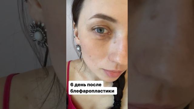 Нижняя трансконьюктивальная блефаропластика , блефаропластика нижних век, нижняя блефаро