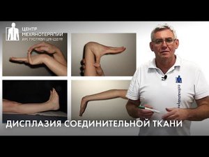 Дисплазия соединительной ткани - причина нарушений осанки, проблем со стопами и др