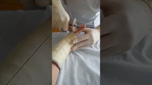 Снять пластиковый гипс