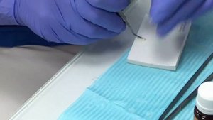 Установка виниров Ӏ Фиксация виниров