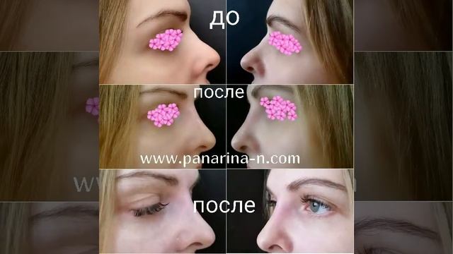 Коррекция спинки носа филлером (Панарина Наталья) смотреть онлайн