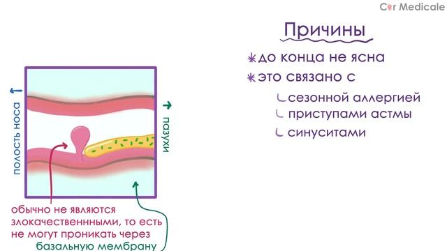 Полипы носа - что такое, причины, методы лечения - кратко