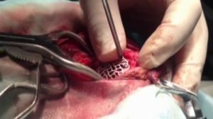 Фиксация титановой сетки при краниопластике